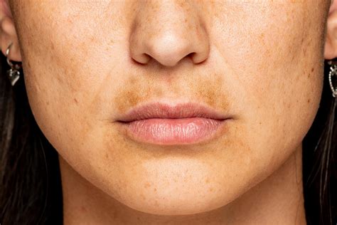Hyperpigmentation